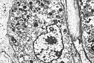 M, 38y. | granular cell tumor M, 38y. | granular cell tumor